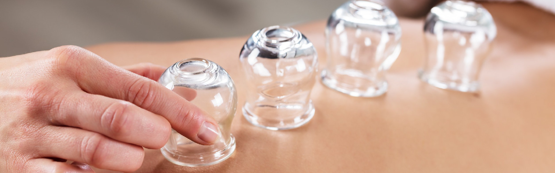 Cupping Therapy near Pine Hills Florida